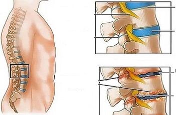 Lomber osteokondrozun gelişiminin nedenleri