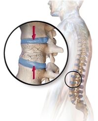 Osteoporoz, alt sırtta sırt ağrısını kışkırtır